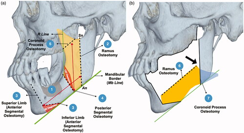 Figure 2. Top picture (a): design of osteotomy; bottom picture (b): rotation of graft. The grey area shows the pathological defect marked with reference to the CT scans. The yellow area indicates the anterior ramus graft. The blue area indicates the remnant coronoid process after the osteotomy. The green lines are the reference lines (Mb Line and R Line). The black dotted lines are the designed osteotomy lines. The black arrows indicate area of deficiency which can be filled by the remnant coronoid process.