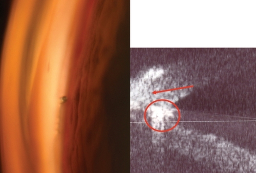 Figure 2 Left: The gonioscopic view of the stent. Right: The UBM shows the hyperechogenic structure of the stent (circle), placed below the corneal wedge (arrow).