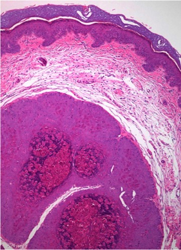 Figure 4 Large intracytoplasmic eosinophil inclusion bodies called Henderson-Petterson bodies. This photo was provided courtesy of Alejandra Villarroel-Pérez, MD. H&E, 10× magnification.