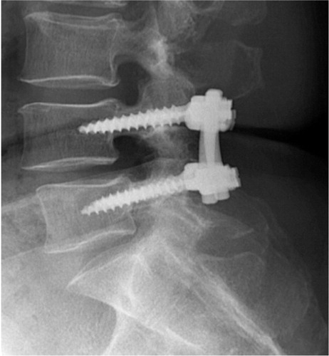 Figure 13. Post operative radiograph, of the lumbar spine showing pedicle screw fixation of the L4-L5 segment.