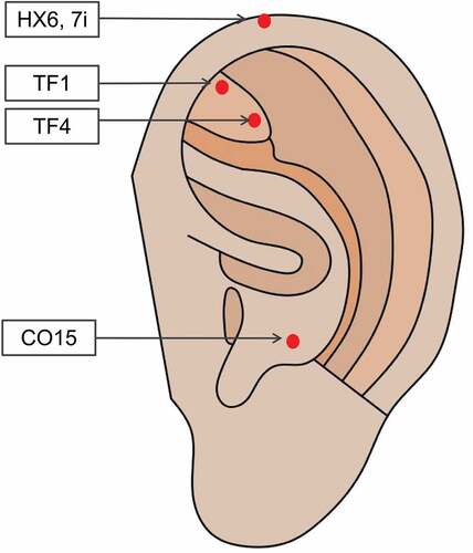 Figure 2. Auricular acupuncture used in the study group.