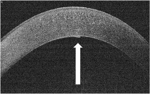 Figure 3 Hyperechogenic Descemet membrane line (arrow) on the OCT 13 months after surgery.