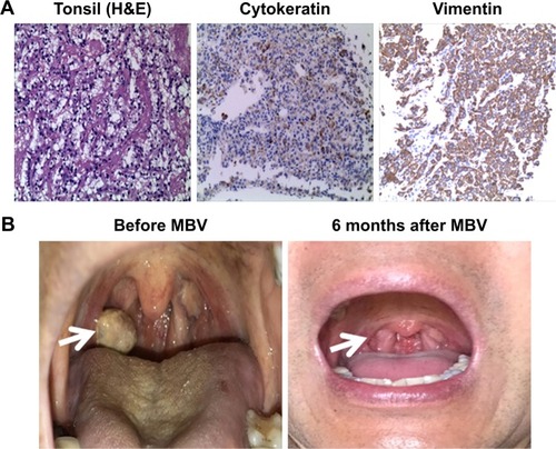 Figure 4 Tonsil metastasis before and after MBV treatment.Notes: (A) Histological examination of tonsil mass. (B) Gross view of tonsil mass before and after MBV treatment (white arrows indicate the tonsil mass).Abbreviation: MBV, mixed bacterial vaccine.