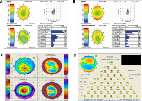 Figure 3 Wavefront analyses shows HOAs and total coma aberration continues 1 year after the ring segment removal (A). Six months after wavefront-guided PRK and CXL, wavefront analyses shows reduction in HOAs and coma aberrations (B). One year after wavefront-guided PRK and CXL, corneal topography (C) and wavefront analyses (D) show stability in keratometric and aberrometric values.