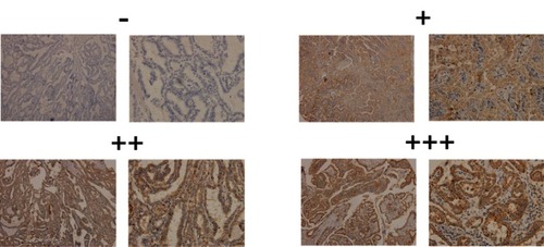 Figure 1 Representative immunohistochemical staining for IDH2 in thyroid tissues.Notes: Tissue arrays were performed on 187 thyroid cancer specimens and 43 matched adjacent normal tissues by IHC staining. The final score was the multiplication product of these two scores. 0–1 score (–), 2–4 scores (+), 5–8 scores (++), and 9–12 scores (+++). Overexpressed values are denoted by (++) and (+++).