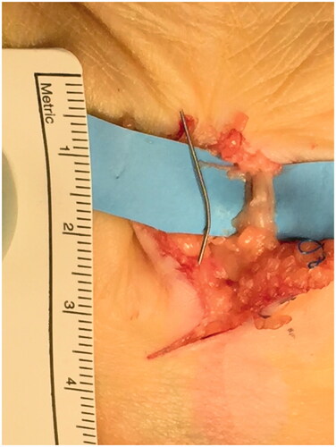 Figure 3. Metallic foreign body removal (20 m × 1 mm).
