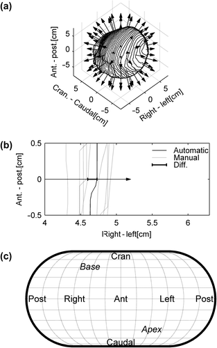 Figure 1. Illustration of the mapping of spatial differences between automatic and manual delineations. a) an automatic heart delineation in 3D. Along the surface of the heart the deviation between manual and automatic segmentations is mapped as illustrated by the arrows. b) one of these arrows in 2D showing how the difference is calculated between the median manual delineation and the automatic. These differences along the surface of the heart are mapped using an Eckert IV projection, with anatomical directions as shown in c).