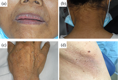 Figure 2 Atypical skin manifestations around the mouth (a), posterior neck (b), back of the hand (c), and armpit (d).