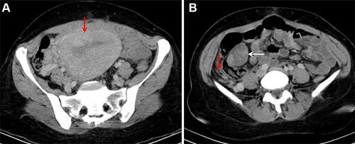 Figure 2 Axial contrast-enhanced abdominopelvic computed tomography images showing presence of enlarged uterus (red arrow) (A) consistent with early postpartum period and a normal appendix (red arrow) (B). Also note the non-enhancing ovarian mass (white arrow).