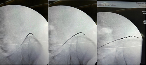 Figure 5 Peripheral stimulator lead placement demonstrated at 30-degrees, 15-degrees, and transverse.