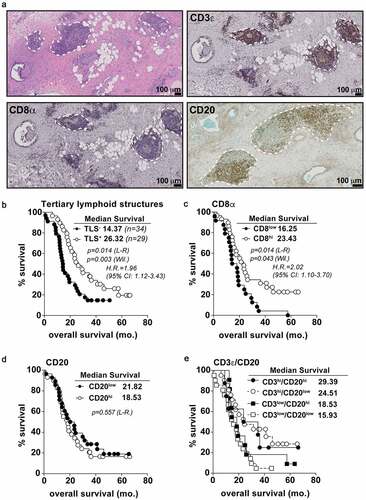 Figure 1. T and B cell aggregates in untreated PDAC tumors predict overall survival. A) Histological micrographs (10x) representative of TLS+ PDAC patients from the PCI cohort. From top left to bottom right: H&E, CD3 IHC, CD8 IHC, and CD20 IHC. TLS regions are outlined in dashed white lines. B) Kaplan-Meier plots displaying overall survival stratified for TLS positivity. Every data point is shown regardless of censor. C-E) CD8 univariate (c), CD20 univariate (d) and CD20/CD3 multivariate (e) analysis for overall survival. Log-rank comparison between CD3hi/CD20hi and CD3hi/CD20low groups non-significant at p = .701. Median cut points were determined for hi vs. low infiltration for all IHC markers. L-R = Log-rank; Wil. = Wilcoxon; H.R. = Hazard ratio; CI: confidence interval. Statistical comparisons were made between all groups. If no p-value is displayed, the comparison was not statistically significant