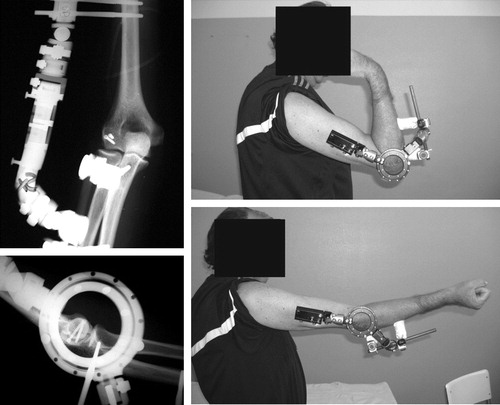 Figure 2.  Case 4. Postoperative radiographs showing internal fixation with screws and hinged fixator. Photographs 3 weeks after surgery showing recovery of motion.
