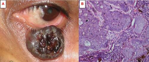 Figure 2 (A) Clinical photograph of a pigmented basal cell carcinoma on the left lower eyelid. (B) Microphotograph of a basal cell carcinoma showing nests of atypical pigment-laden basal cells with peripheral palisading and mitotic figures.