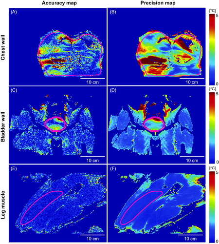 Figure 3. Temperature accuracy and precision maps for the chest wall, bladder wall, and leg muscle based on the MR temperature maps shown in Figure 2.