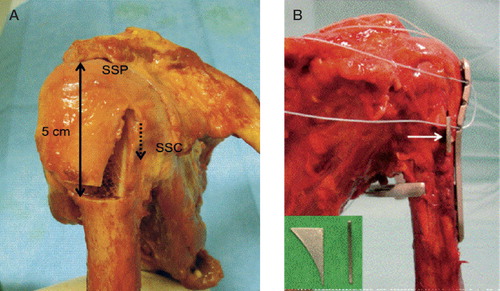 Figure 1. A. Right shoulder: osteotomy of the greater tuberosity. SSP: M. supraspinatus; SSC: M. subscapularis; ….> bicipital groove. B. Placeholder (superimposed display and arrow) in gap l to retain a 2-mm gap between the head and greater tuberosity fragment during plate fixation.