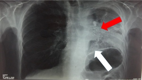 Figure 4 After 65 days from the afatinib 40 mg administration (white arrow indicates the part of the left lower lobe that has been inflated and red arrow indicates the central mass that used to totally block the left lung).