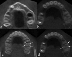 Figure 1. (a) Axial CBCT image showing one root, (b) three canals of the first molar, (c) four canals (arrows) and (d) C-shaped canal of the second molar (arrows).