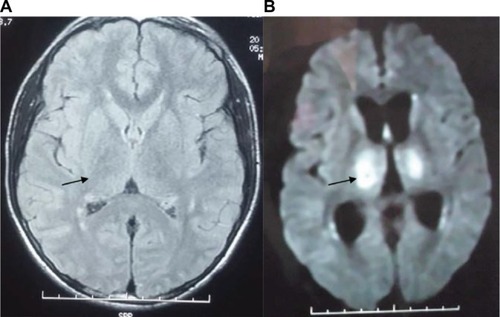 Figure 3 MRI showing thalamic hyperintensities (arrows). T2 weighted image (A); diffusion weighted image (B).