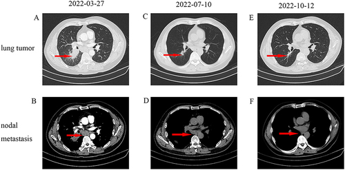 Figure 1 (A and B) Baseline CT images. The red arrow in figure A indicates tumors and the red arrow in figure B indicates lymph nodes. (C and D) Lung mass and nodal metastasis achieved PR after four cycles of AP (albumin paclitaxel 400 mg and carboplatin AUC 5) and sugemalimab 1200 mg. The red arrow in figure C indicates tumors and the red arrow in figure D indicates lymph nodes. (E and F) Lung mass achieved SD, and nodal metastasis achieved CR after five cycles of 1200 mg of sugemalimab. The red arrow in figure E indicates tumors and the red arrow in figure F indicates lymph nodes.