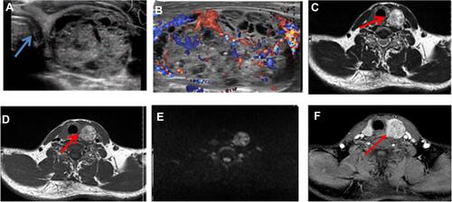 Figure 3 Images from a representative PTC patient with extensive ETE in the left thyroid lobe (male, 46 years old). (A) Transverse view of US image shows (under-diagnosis) displaying an oval-like hypoechoic mass beside the left lobe of the thyroid near the trachea (blue arrow), no invasion of tracheal mucosa, (B) CDFI showing a smaller blood flow signal in the periphery and interior; (C) T2WI image, (D) T2WI image, (E) the DWI imaging, and (F) fat-saturated contrast-enhanced T1WI image shows the mixed-signal lesion, which was round and had partially broken through the thyroid capsule and invaded the trachea (red arrow).