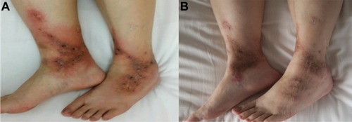 Figure 4 Case 3: before the treatment of rivaroxaban (A) and after the treatment of rivaroxaban (B).
