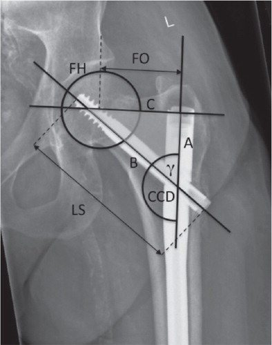 Figure 2. A pertrochanteric fracture treated with proximal femoral nailing. Anatomic and implant measurements are shown. A – proximal nail shaft axis, B – leg screw axis, C – perpendicular line from the center of rotation of the femoral head to the long axis of the proximal part of the femoral nail shaft, FH – femoral head, FO – femoral offset, LS – leg screw, CCDP – projected caput-collum-diaphyseal angle, γP – projected gamma angle of the implant.