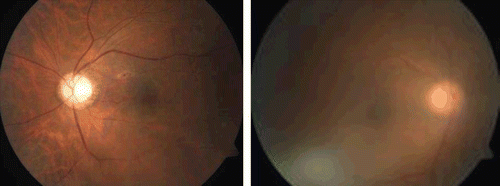 FIGURE 1  (A) Fundus photograph of the left eye showing presence of Roth’s spot. (B) Fundus photograph of the right eye showing mild to moderate vitritis.