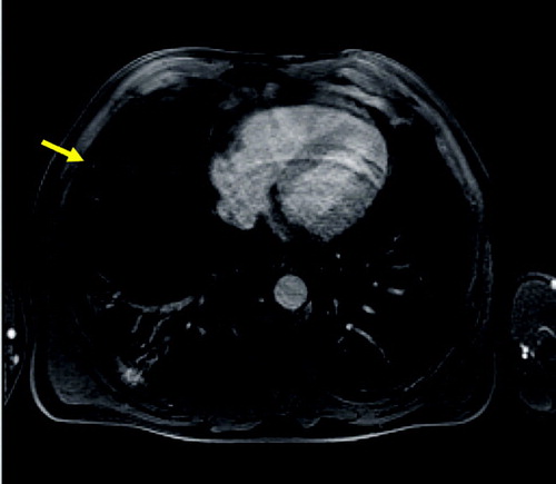 Figure 2 T1 weighted axial GRE (VIBE): small nodule in the right middle lobe (arrow) and dystelectatic changes in the right lower lobe.