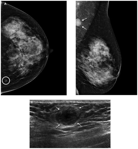 Figure 4 Plasmacytoma of the breast. Left mammogram shows (A) a small well defined mass (circle) in the left craniocaudal view and (B) an abnormal lymph node (arrows) in the mediolateral oblique view. (C) Ultrasound shows a hypoechoic mass (arrows) with hyperechoic rim.