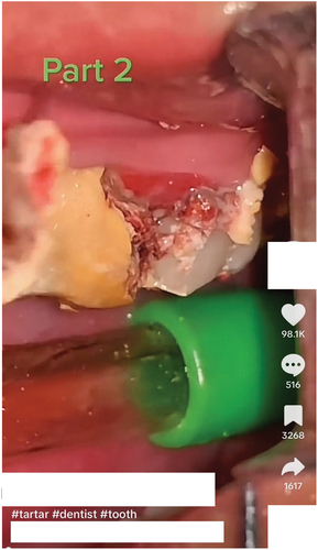 Figure 2. An example of a TikTok video posted with #dentist with the sentiment categorized as “fear.” The video portrays a close-up recording of a deep dental cleaning in which the teeth are covered in calculus; after the ultrasonic scaler removes calculus, blood seeps from the gums, while the theme song from the horror film “Halloween” plays in the background.