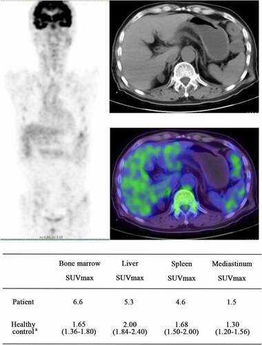 Figure 5. The images of whole body 18F-FDG-PET/CT. a:(median, quartile), SUVmax of healthy people who underwent 18F-FDG-PET/CT examination at our hospital; In the whole-body 18F-FDG-PET/CT images, the higher that the tissue uptake rate of FDG is, the higher that the SUV value is, and the darker that the color in the image is. As the SUV value rises, the image color changes from blue to green, yellow, or even red. Abbreviations: SUVmax, maximum standardized uptake value; 18F-FDG-PET/CT, 18F-fluorodeoxyglucose (18F-FDG) positron emission tomography and computed tomography (PET-CT)