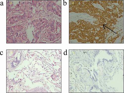 Figure 1. Expression of STIM1 in NSCLC and benign pulmonary diseases tissues. (a) Hematoxylin and eosin staining of lung adenocarcinoma. (b) Immunohistochemical staining of STIM1 protein in the cytoplasm of NSCLC cells. (c) Hematoxylin and eosin staining of tissues from a benign pulmonary disease. (d) Negative immunostaining for the STIM1 protein in a benign pulmonary disease. Scale bar: 20 μm. STIM1, stromal interaction molecule 1; NSCLC, non-small-cell lung cancer.