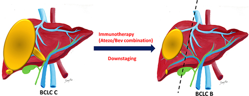 Figure 6 Downstaging by ICI or Atezo/Bev combination.