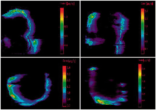 Figure 3. Results of LA-ICP-MS. Upper left: normothermic without bevacizumab (63.75%); upper right: hyperthermic without bevacizumab (93.53%); under left: normothermic with bevacizumab (43.18%); under right: hyperthermic with bevacizumab (45.18%). Blue line: tumour border. Coloured parts: platinum concentration from 0.1 µg/g (purple) upwards.