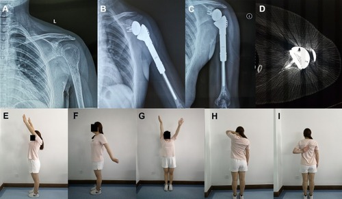 Figure 5 A 23-year-old female patient with Campanacci grade III GCT of bone underwent RSA following en bloc resection of the left proximal humerus.Notes: (A) Preoperative X-ray image; (B) postoperative X-ray image 5 months after surgery; (C) postoperative X-ray image 12 months after surgery; (D) the transaxial CT scanning of right shoulder joint obtained 16 months after surgery showed osteointegration; (E–I) at the last follow-up, the patient recovered satisfactory contour and function of the shoulder.Abbreviations: GCT, giant cell tumour; RSA, reverse shoulder arthroplasty.