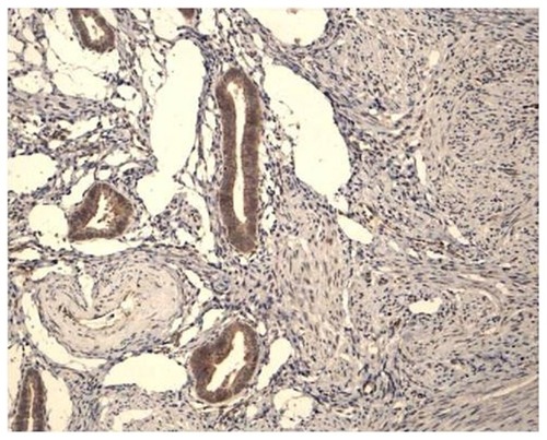 Figure 6 Cox-2 expression in a patient with adenomyosis during the proliferative phase.