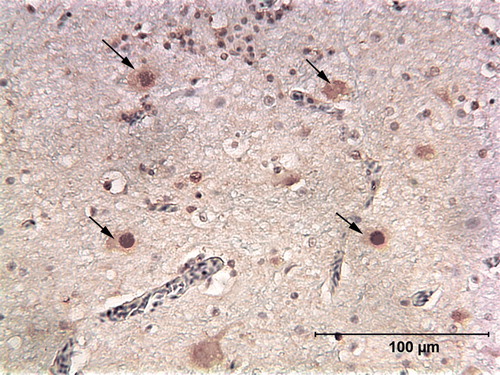 Figure 3.  Immunoperoxidase-stained cerebrum of a blue and gold macaw (Case 0437). Cells staining for ABV N-protein are scattered through the cerebral tissue. Note that their nuclei are more heavily stained than their cytoplasm, an expected property of ABV nucleoprotein. Arrows point to stained cells.