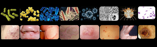 Figure 2 Common skin infections treated by hydrogels.