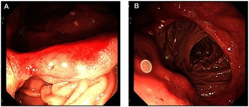 Figure 2 Gastroscopy showed anastomotic inflammation (A) and post-gastrectomy (Billroth II) (B) before duplication cysts resection.