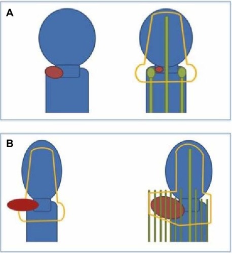 Figure 1 Selecting intracavitary versus interstitial brachytherapy.