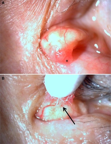 Figure 1 Clinical appearance of the tumor of the lacrimal caruncle at the first visit.Notes: (A) Outside of the tumor. It appeared smooth surface and was whitish with dilated capillaries. In addition, the apical portion of the tumor had a papilloma-like appearance with mild hyperemia (*). (B) Backside of the tumor. The “navel-like structure” was observed near the center of the lesion in the backside (arrow).