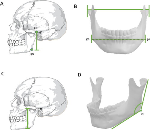 Figure 2. Metric analyses with statistical significance in sex estimation — mandible. (A) Condylion–gonion distance. (B) Bigonial width and bicondylar distance. (C) Mandibular length. (D) Gonial angle. These measurements exhibit greater values in males, whereas the gonial angle is usually smaller in males than in females co: coronion; go: gonion.