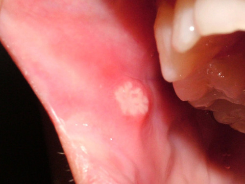 Figure 2 A recurrent oral ulcer on the buccal mucosa.