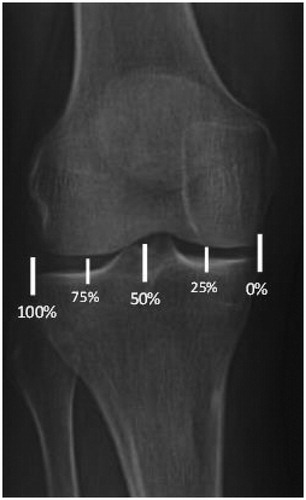 Figure 1. Weight-bearing alignment as described by Noyes et al. [Citation10–12,Citation25]. The medial edge is designated as 0% and the lateral edge as 100%. A line is drawn from the center of the femoral head to the center of the tibiotalar joint and is measured at the point where the line intersects the tibial plateau.