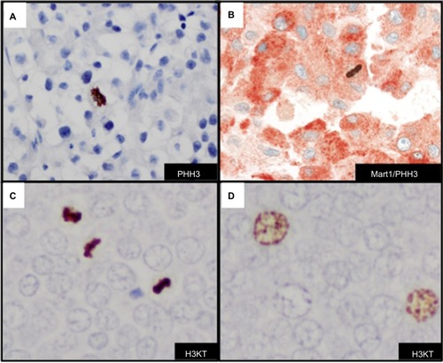 Figure 5 Detection of mitotic figures and G2+ tumor nuclei with histone markers.