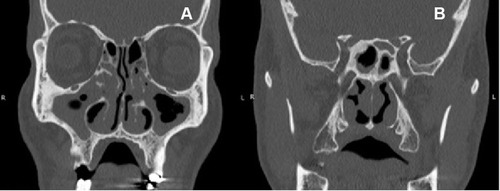 Figure 2 High-resolution computed tomography of the sinuses. (A) Shows a mucosal thickening in both maxillary and ethmoid and (B) sphenoid sinuses with diagnosis of chronic sinusitis.