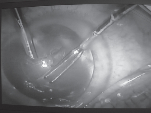 Figure 1 Continuous circular capsulorhexis under continuous irrigation with the irrigating chopper.