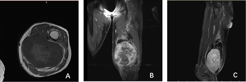 Figure 2 A 72-year-old female patient with a dedifferentiated liposarcoma in her left popliteal fossa. (A) T1-weighted image shows an indistinct soft tissue mass in the left popliteal fossa, predominantly consisting of low-signal non-fat areas and displaying heterogeneous signal. Additionally, there is an irregular area of moderate signal at the center. Irregular fat signal is visible at the edge of the mass; (B) Fat-suppressed T1-weighted image; (C) Fat-suppressed T2-weighted image shows suppressed low signal fat areas and high signal non-fat areas, as well as thick septations within the fat areas.