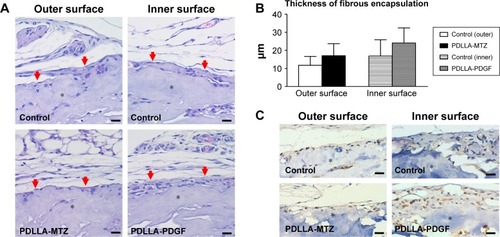 Figure 3 The preclinical assessments of FGM biocompatibility in vivo.Notes: (A) Histology from the interface of the membrane and the surrounding subcutaneous tissue after 2 weeks of implantation. Asterisks indicate the matrix of the membrane, and red arrows indicate the fibrous encapsulation on the surface of the membrane. Magnification: 100×. Scale bar: 20 μm. (B) Quantification of the thickness of fibrous encapsulation. (C) Immunohistochemistry showing PCNA-positive cells (cells with brown nucleus staining) on the membrane surfaces. Asterisks indicate the matrix of the collagen core of the membrane. Magnification: 100×. Scale bar: 20 μm.Abbreviations: FGM, functionally graded membrane; MTZ, metronidazole; PCNA, proliferating cell nuclear antigen; PDGF, platelet-derived growth factor; PDLLA, poly(l-lactide-co-d,l-lactide).