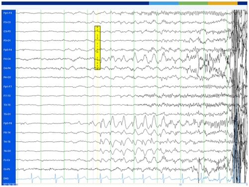 Figure 3A The onset of one of the seizures recorded with the scalp EEG. The EEG trace shows a simultaneous onset in the right temporal and frontal regions, involving the electrodes F4, Fp2, F8, T4 and some spread to T6.